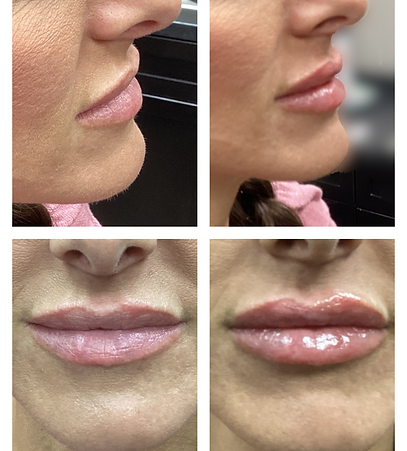 Hyaluronic acid (HA) fillers