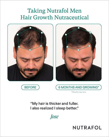 Nutrafol Men Hair Restoration in Appleton, WI