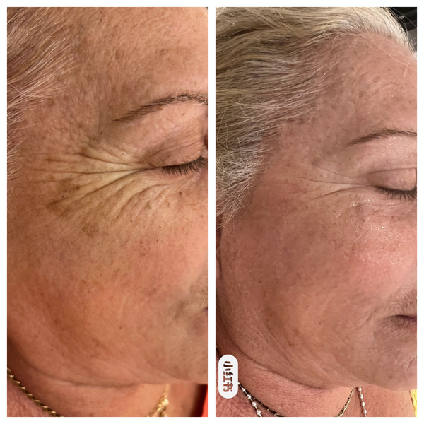 Before and after comparison showing dramatic skin transformation from fractional C02 laser treatment with glowing, rejuvenation skin results"