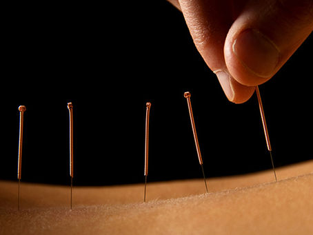 dry needles applied to a back for pain relief