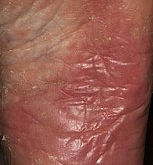 Athlete's Foot / Tinea Pedis