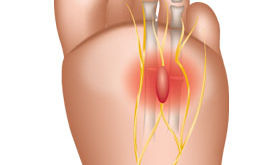 Morton's Neuroma
