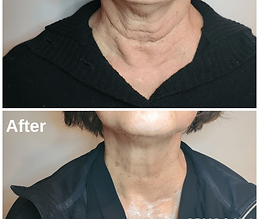 CryoFacial-neck-tightening-photo-credit-_aesthetics_by_sophia.png