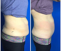 6-Slimming-treatments.jpg