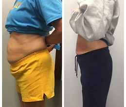 15-slimming-treatments-_thrivecryostudio.jpg