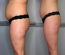 3-slimming-3-toning-treatments-give-credit-to-_tnhydration-1.jpg