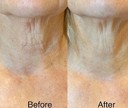1-neck-toning - - give credit to Cryo Body Creation Jasper.jpeg