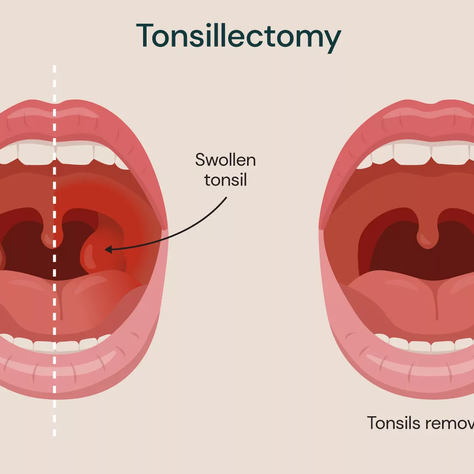 "Tonsillectomy Time: When and Why Tonsils Need to Come Out"