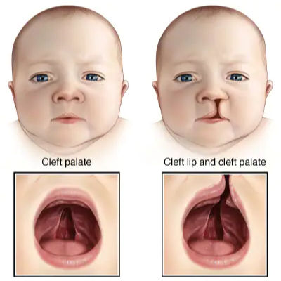 "Cleft Lip and Cleft Palate: Surgical Options and Support for Children"