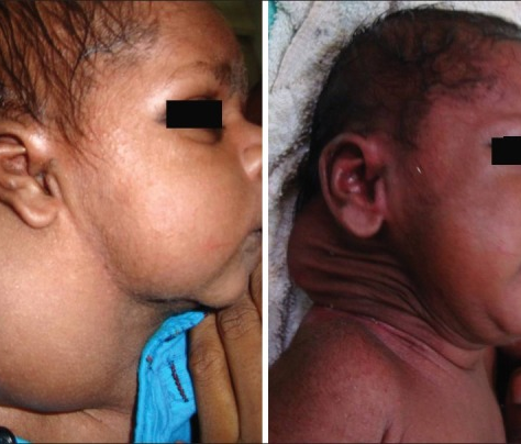 "Bleomycin: A Sclerosing Agent for Lymphangiomas in Children"