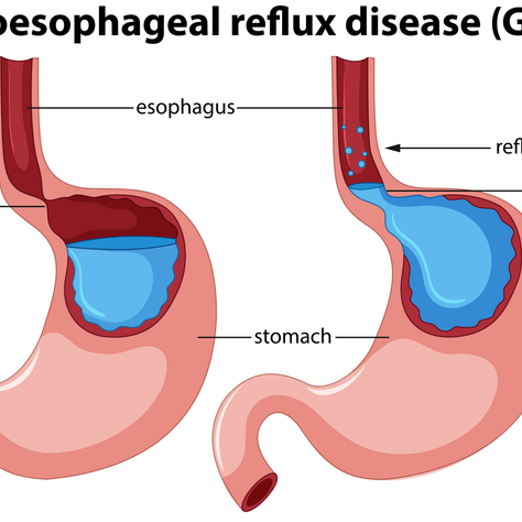 "Feeding Challenges? Exploring Surgical Options for Gastroesophageal Reflux Disease (GERD) in Children"