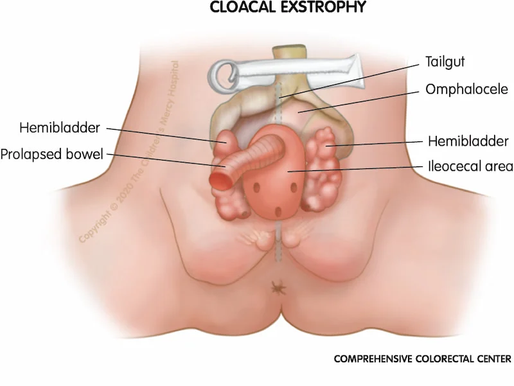 "Cloacal Exstrophy: A Comprehensive Review of Current Management and Treatment Options"