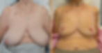 Before and After Nipple-Sparing Goldilocks Mastectomy