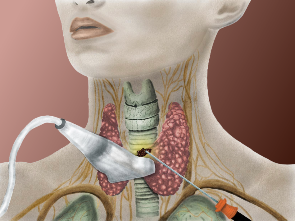 V54N4_RFA_thyroid_ultrasound.png