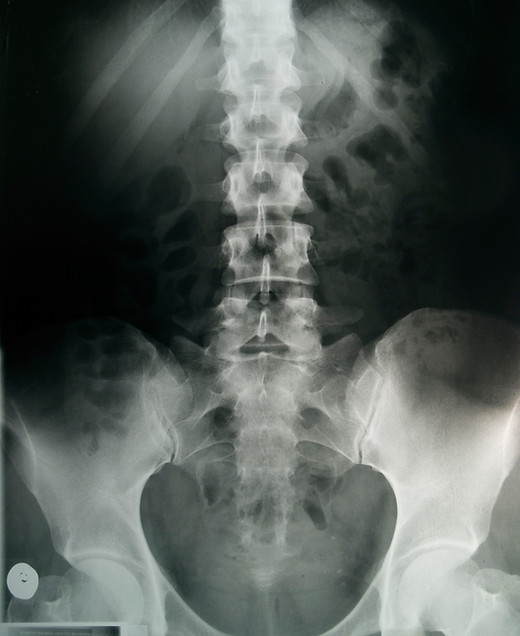Pelvic X-Ray