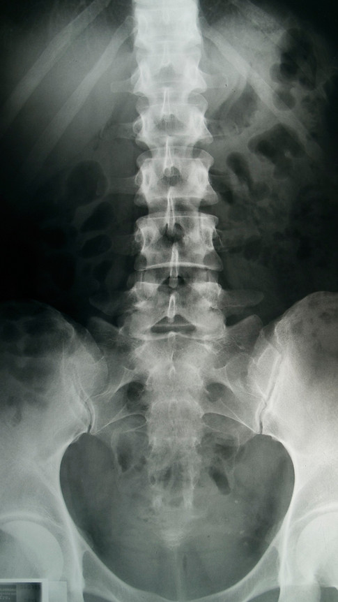 Spinal X-Ray
