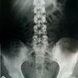 Understanding Spinal Cord Injuries