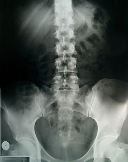 Osteoporosis Screening