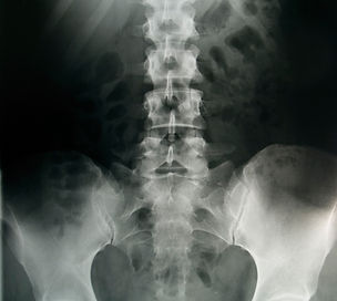 Xray of lower back