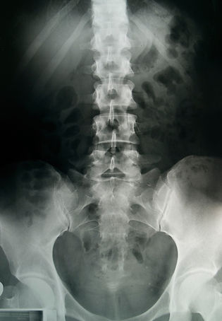 Spinal X-Ray