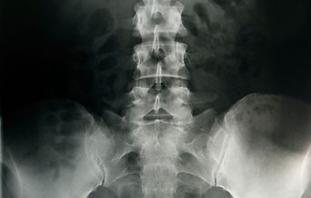 脊椎X線スキャン