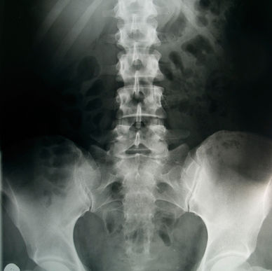 Pelvic X-Ray