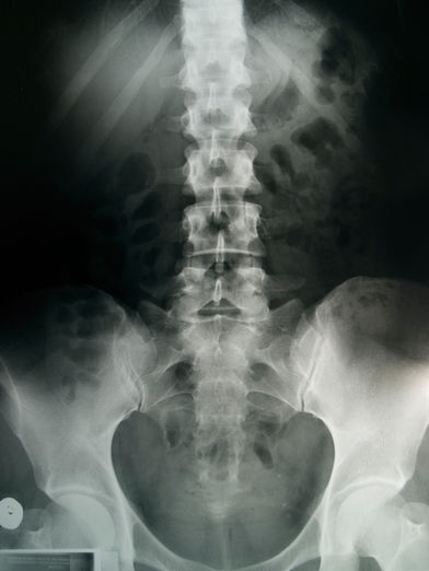 Pilates for Bone Health