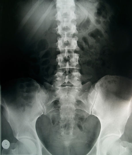 Pelvic X-Ray