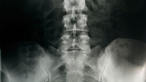 Sciatica