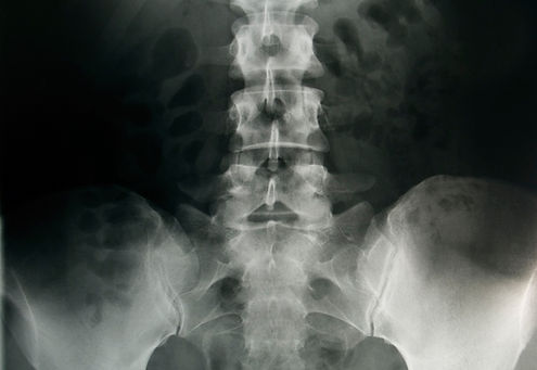 Pelvic X-Ray