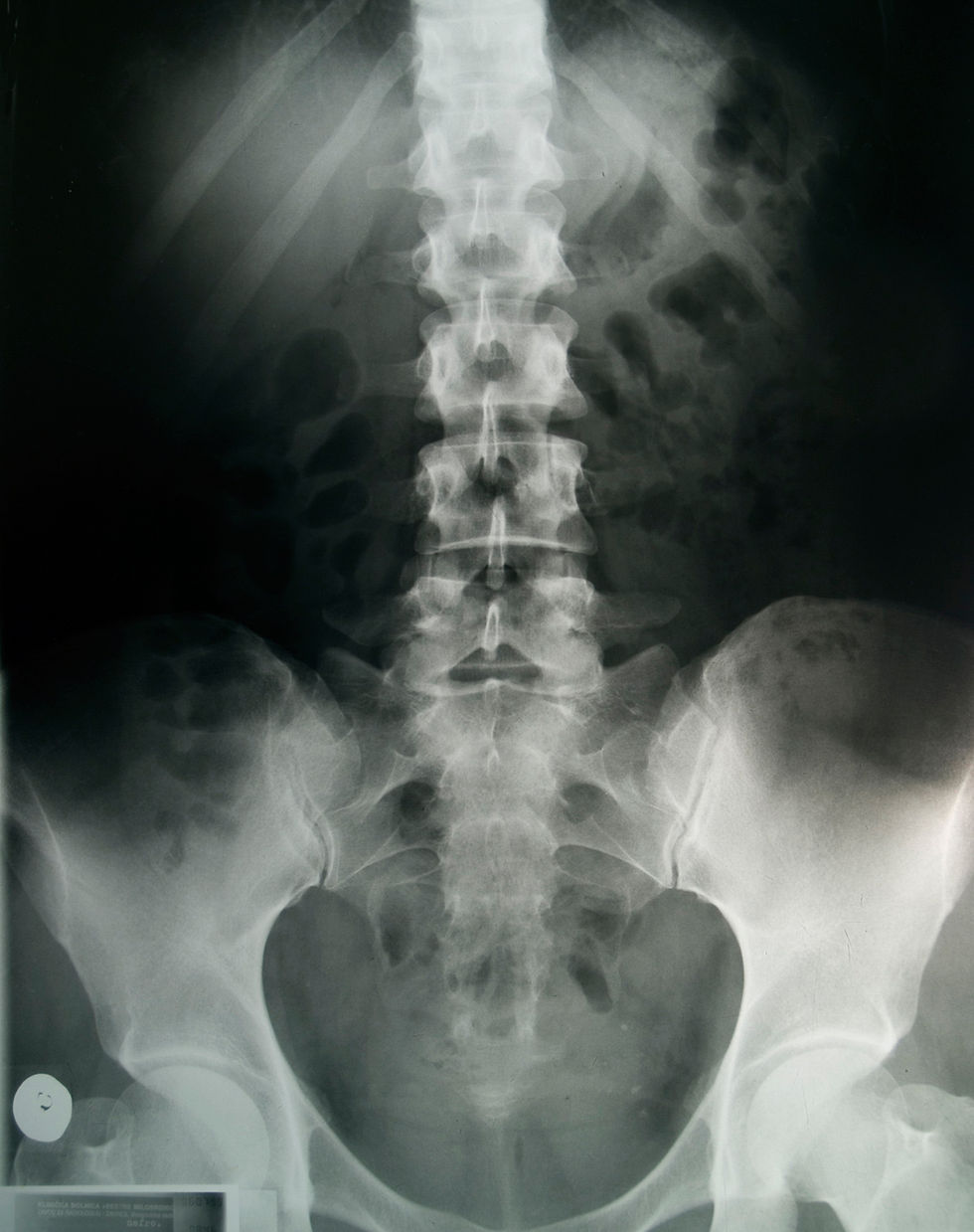 Spinal X-Ray