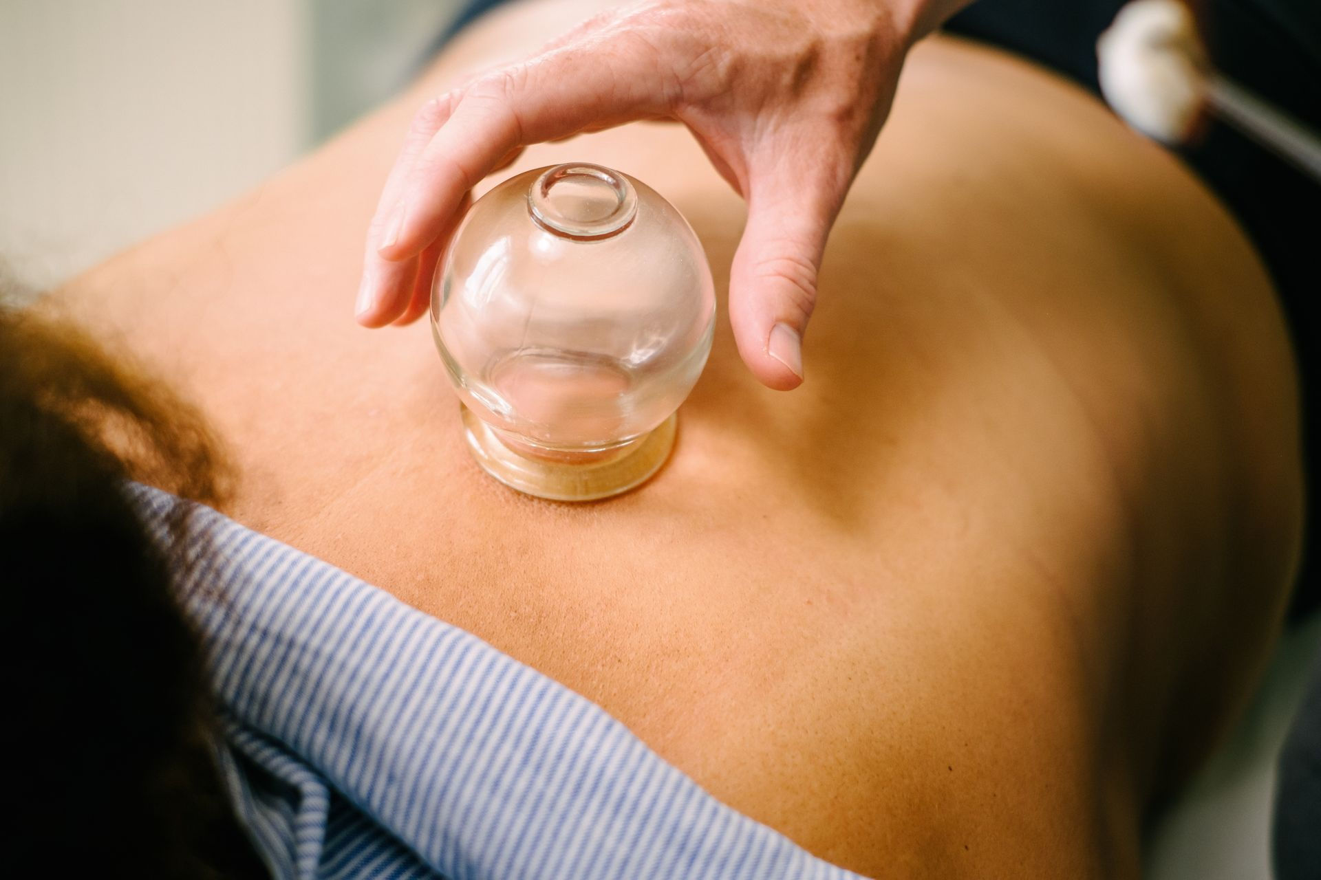 Suction cups applied to a patient's back during cupping therapy.