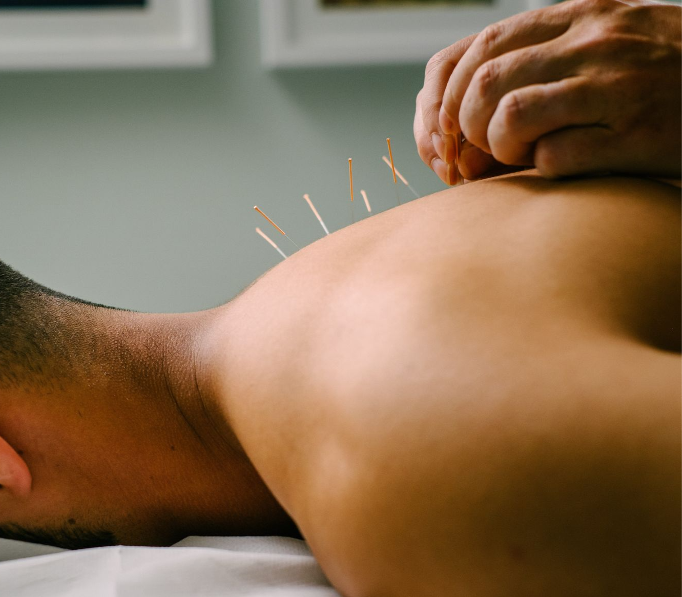 Acupuncture needles being placed in a person's back