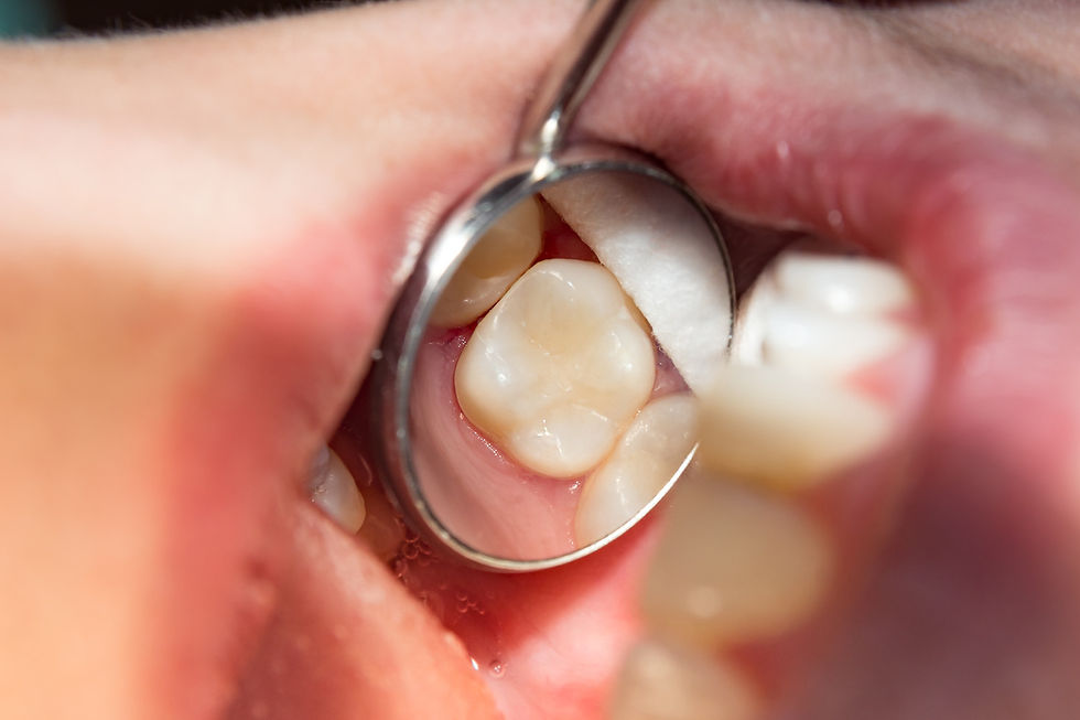 A dental filling at American Family Dentistry in Scottsdale AZ