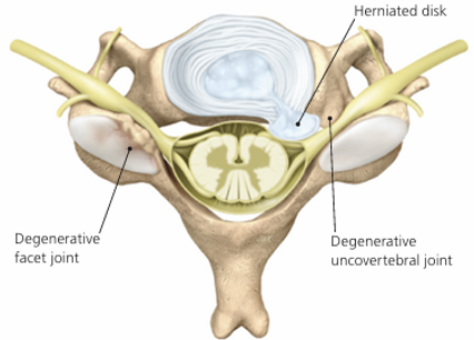 Cervicale radiculopathie, hernia, stenose, slijtage, nekpijn uitstraling arm