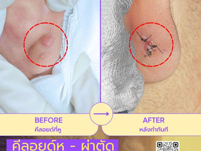 รีวิวผ่าตัดคีลอยด์เจาะหู ที่W+medic Clinic นนทบุรี
