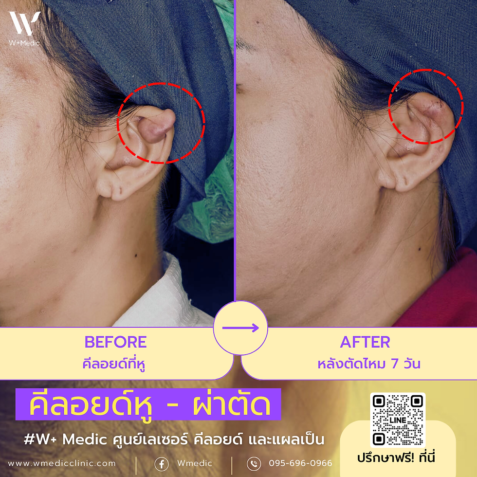 ผ่าตัดคีย์ลอยด์หู