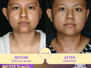 ผิวสะอาด เรียบเนียนขึ้นทันตา ด้วยเลเซอร์CO2 ที่ออกแบบเพื่อคุณ