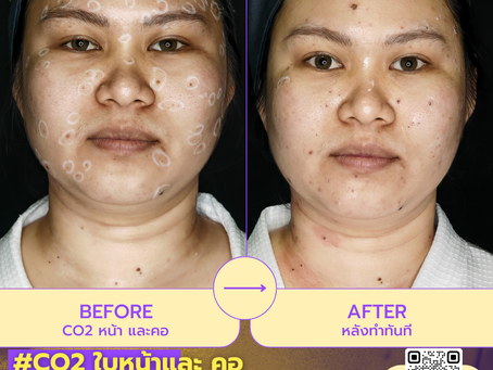 เลเซอร์CO2 ใบหน้าและคอ คืนผิวเรียบเนียน มั่นใจแบบไม่ต้องแต่งกลบ
