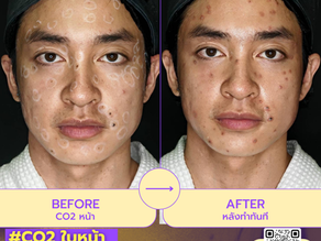 เคลียร์ผิวให้สะอาดขึ้นในครั้งเดียว เลเซอร์CO2 ใบหน้า ที่ W+ Medic Clinic