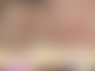 👃 เลเซอร์CO2 ลบไฝบริเวณจมูก ผิวเรียบขึ้นใน 14 วัน