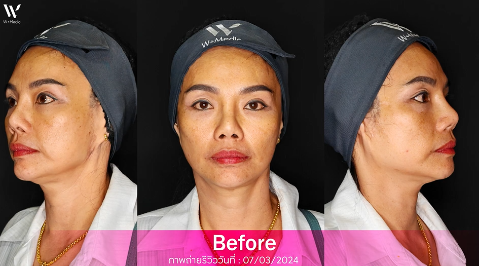 รูปภาพก่อนฉีดSculptra!