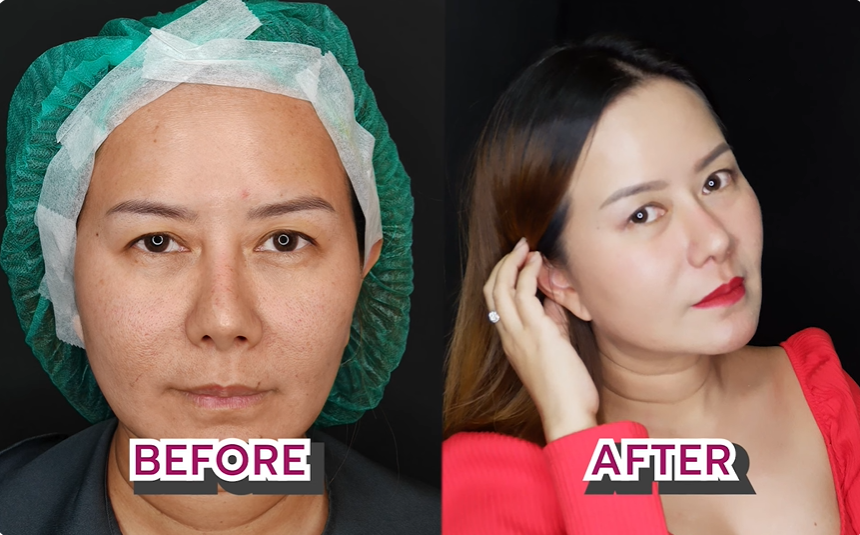 รีวิวฉีด Sculptra ดีไหม?