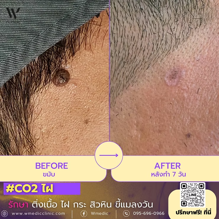 เลเซอร์CO2