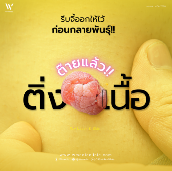 ติ่งเนื้อ ลักษณะแบบไหนอันตราย รีบบเอาออกด่วน!!