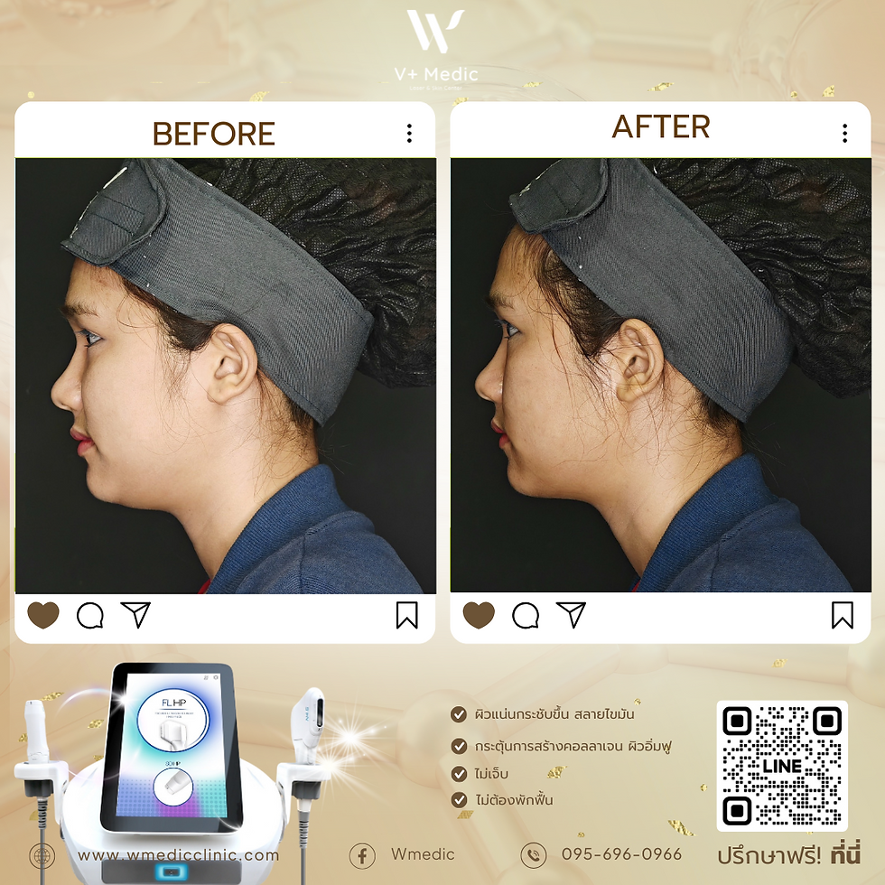 ผลลัพธ์หลังกระชับหน้าทันที่ W⁺ Medic Clinic นนทบุรี