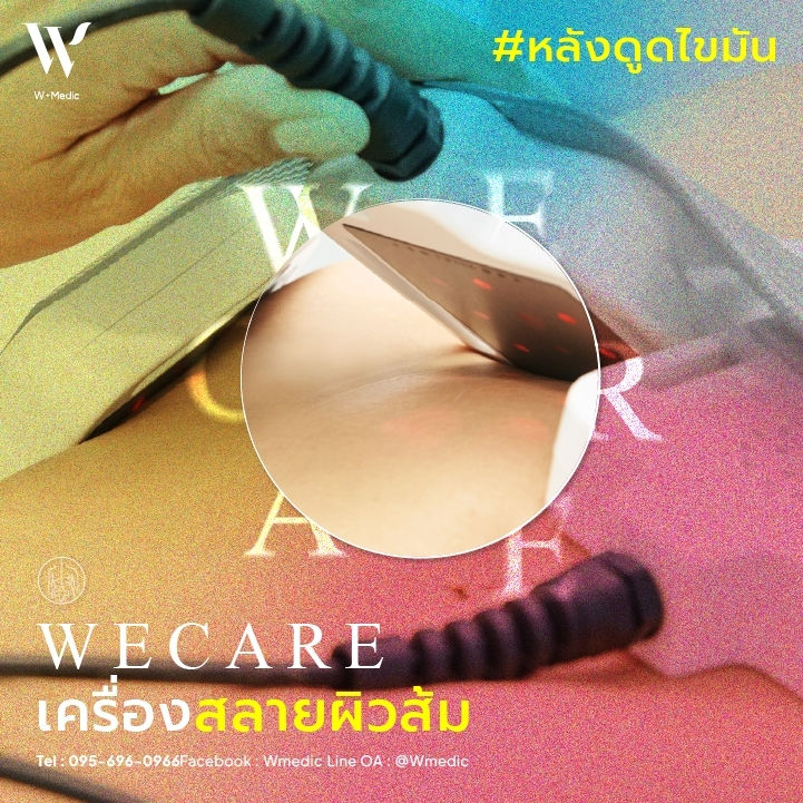 "ผิวเปลือกส้ม" หรือ Cellulite เป็นปัญหาผิวที่หลายคนเผชิญ ซึ่งเกิดจากการสะสมของไขมันใต้ผิวหนัง