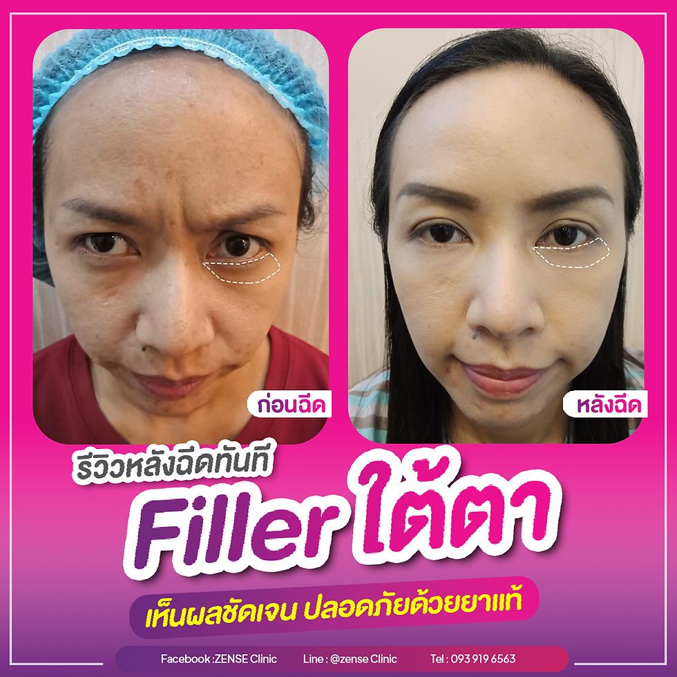 الصورة المصغرة: Promotion - Filler Neuramis 4999