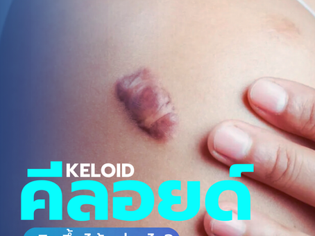 KELOIDคีลอยด์…เกิดขึ้นได้อย่างไร? 🥺