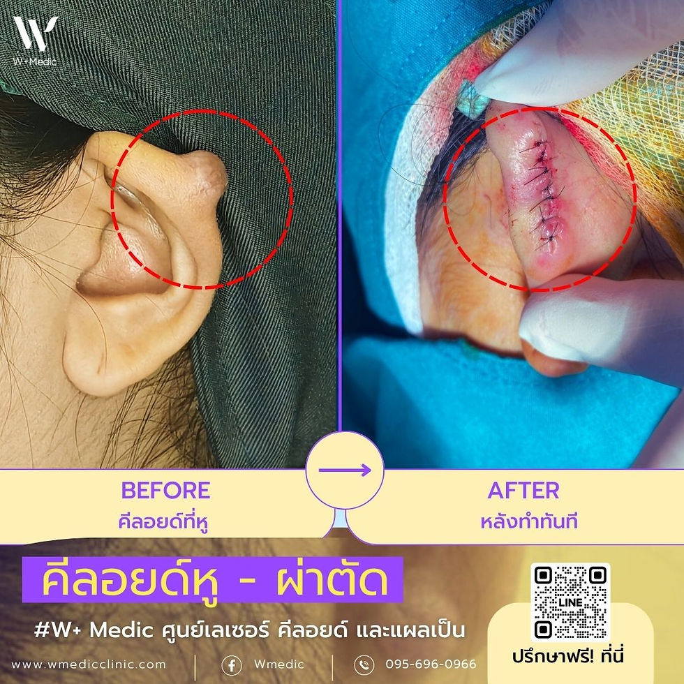 คีลอยด์